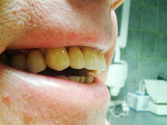 Detailní záběr na tvar a povrchovou texturu můstku po nacementování v ústech pacienta.