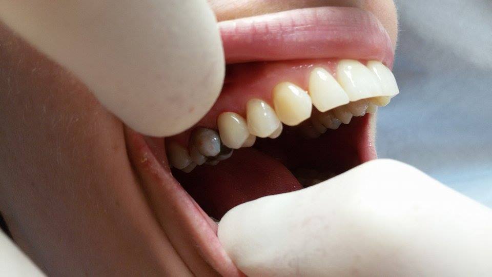 Hotová korunka v ústech pacienta.