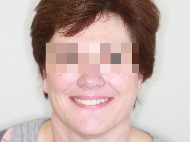 Keramicke fasety a korunky