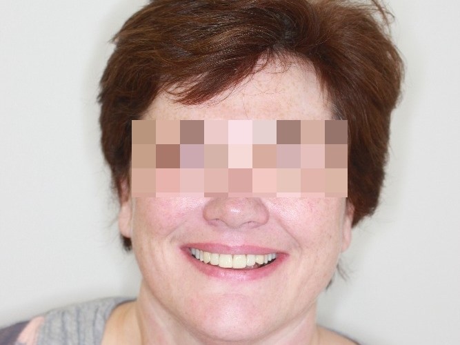 Keramicke fasety a korunky